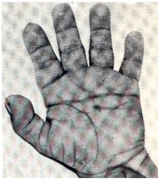 Figura 7 - mano característica de un niño con Síndrome de Down: SIMEA pliegue en plama y al menos un dedo de plegado. Fuente: Página "Síndromes y el mal" [4]