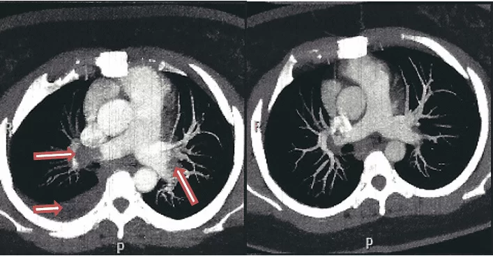 Figura 2 – A) Angiotomografia de tórax com injeção de contraste, evidenciando tromboembolismo pulmonar e derrame pleural à direita. B) – Tomografia Computadorizada de controle pós trombólise mostra dissolução parcial dos trombos presentes nas artérias pulmonares, redução do calibre das artérias pulmonares e resolução completa do derrame pleural. FONTE: Prontuário clínico. 2016.