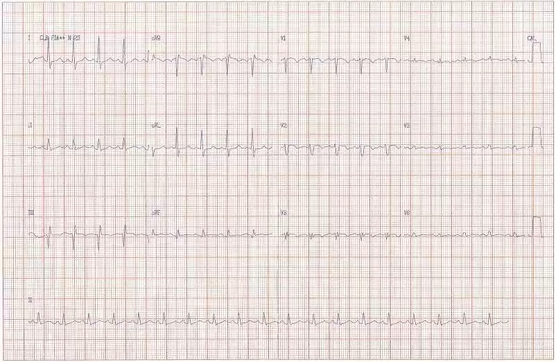Figura 1 –Eletrocardiograma – Padrão S1Q3T3, não progressão da onda R de V1 a V4, alteração da repolarização (inversão da onda T de V1 a V4). FONTE: Prontuário clínico. 2016.