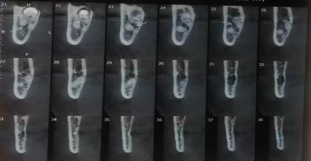 Figura 1: TC da relação do NAI com as raízes do terceiro molar inferior com corte coronal. Fonte: Próprio Autor