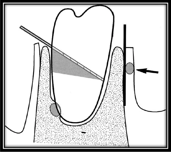 Figura 2: Diagrama representativo da técnica do procedimento cirúrgico da coronectomia efetuado. Fonte: Pogrel (2004)