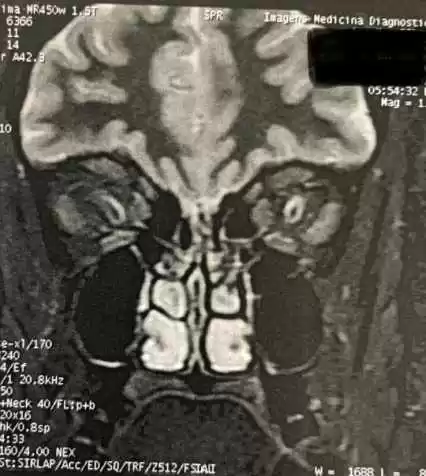 C:\Users\Caio\Desktop\OTORRINOLARINGOLOGIA\fistulas rinogenicas\e611ec16-1944-4f2f-a44f-e9f1e9b69b4b.jpg