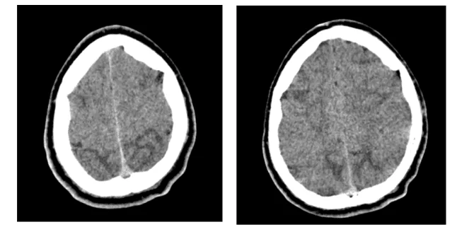 Tomografia Computadorizada do Crânio