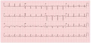 ECG pós-trombólise