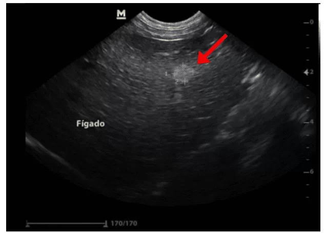 Imagem ultrassonográfica abdominal evidenciando o nódulo hepático de aspecto homogêneo e hiperecogênico, medindo 0,75 cm x 0,64 cm localizado em lobos esquerdos.