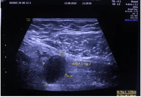 Ultrassonografia da região axilar direita evidenciando linfonodo com atípicas, medindo aproximadamente 1,93 x 1,49 cm
