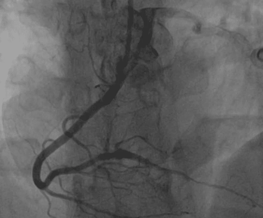 Angiografia coronariana evidenciando a coronária direita após tratamento de angioplastia com stent farmacológico