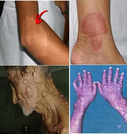 Clinical forms of leprosy