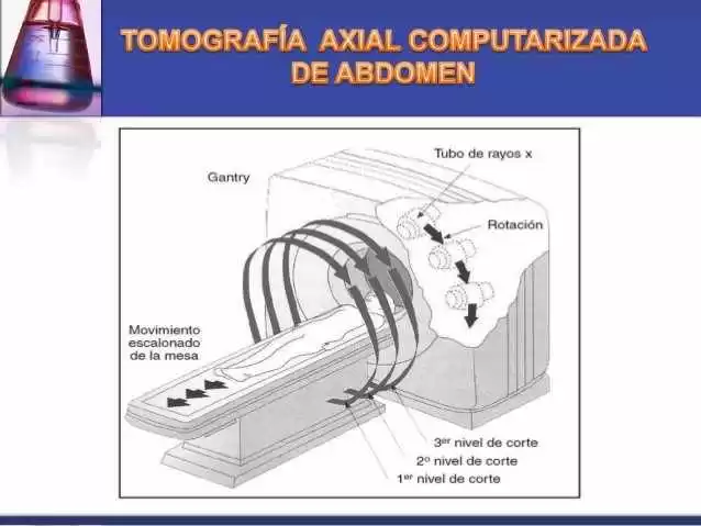Figura 2 - Paciente é movido através do pórtico, para fora e para dentro, enquanto ocorre a rotação do tubo de raios X e o detector descreve uma trajetória helicoidal ou espiral sobre o paciente, adquirindo dados para a imagem com sua rotação.