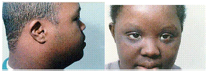 Rostro característico, ojo y el oído del niño con síndrome de Down