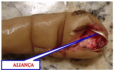 Foto 01 – Acidente com dedo preso no gancho da trave de futebol