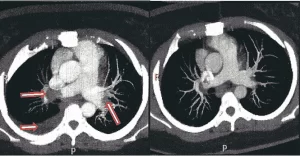 Figura 2 – A) Angiotomografia de tórax com injeção de contraste, evidenciando tromboembolismo pulmonar e derrame pleural à direita. B) – Tomografia Computadorizada de controle pós trombólise mostra dissolução parcial dos trombos presentes nas artérias pulmonares, redução do calibre das artérias pulmonares e resolução completa do derrame pleural. FONTE: Prontuário clínico. 2016.
