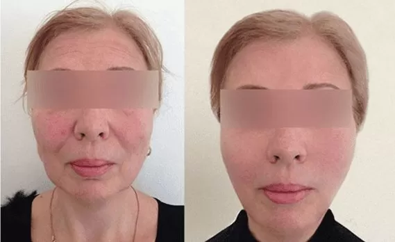 Antes e Depois do procedimento com auxílio de fios de PDO