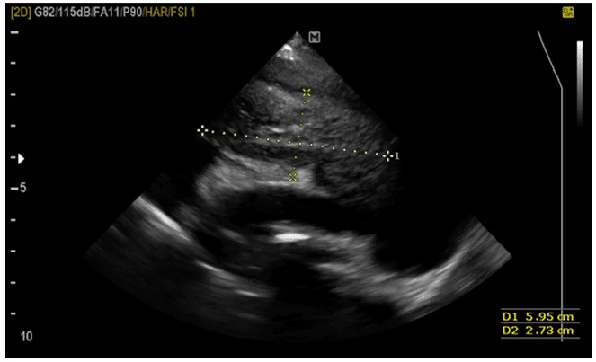 Ecocardiograma (bidimensional e doppler) constatando presença de uma estrutura em mediastino cranial, medindo 5,9 x 2,7 cm, próximo a base cardíaca