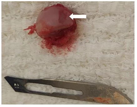 Cabeça do fêmur removida após incisão com serra de oscilação. Lesão óssea causada pela luxação (seta branca).