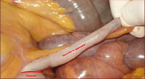 Apêndice vermiforme em posição pélvica