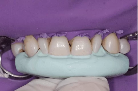Adaptação da matriz de silicone